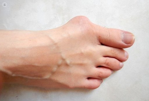 Is Bunion Removal Surgery Worth the Effort.jpg
