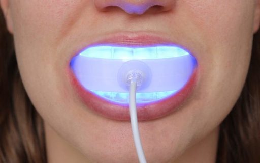 At-Home vs In-Office GLO Whitening Which Option is