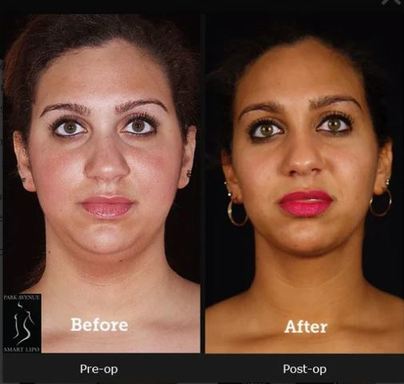 Chin liposuction.JPG