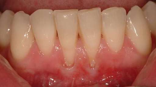 What To Do About Receding Gums.jpg