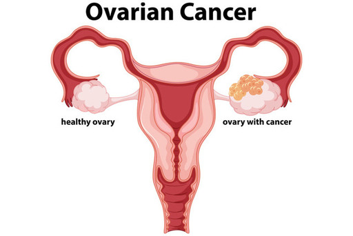 ovarian-cancer.jpg