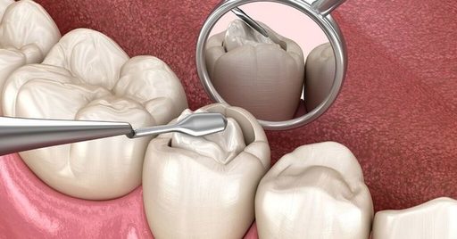 Why You May Want to Get Dental Filling 8 Benefits.