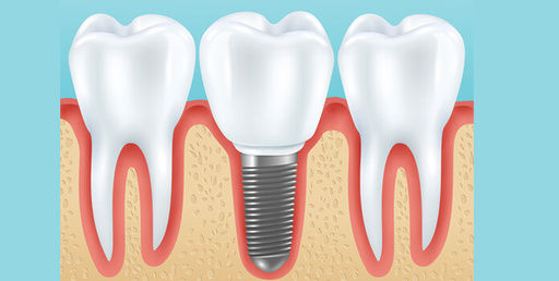 9 Weighty Reasons to Get Dental Implants.jpg