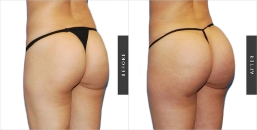 brazilian-buttLift2.jpg