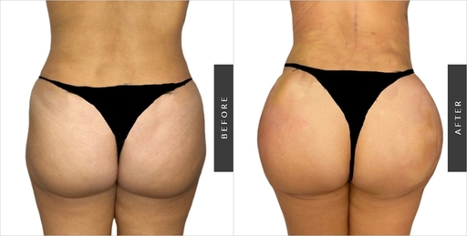 brazilian-buttLift8.jpg