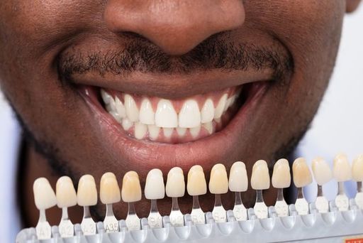 What Will Happen to Your Teeth Under Veneers.jpeg
