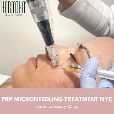 PRP Microneedling Treatment NYC.jpg