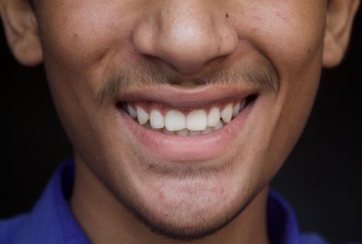 5 Problems Crown Lengthening Can Solve.jpg