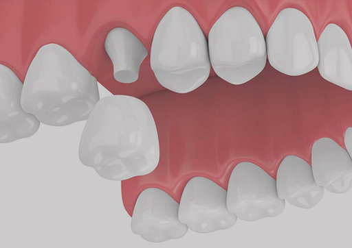 Dental-crown.jpg