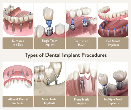 types-of-dental-implant-procedures.jpg
