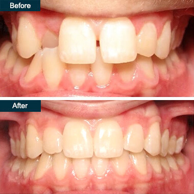 Before-After-Dental-Yonkers-Invisalign.jpg