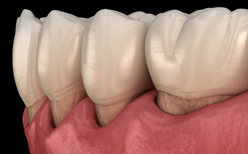 7 Causes of Receding Gums You Shouldn't Ignore.jpg