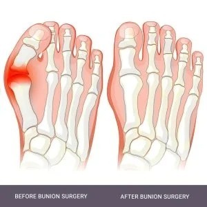 imgi_17_bunion-surgery-nyc-300x300.jpg.jpeg